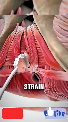 V Tone Procedure Explained