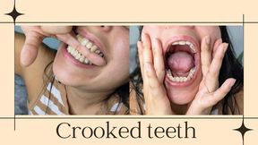Crooked teeth reveal