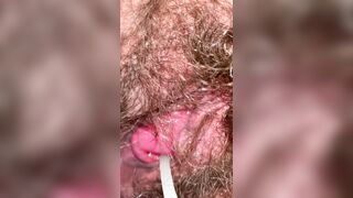 Prolapsed Cervix Penetration