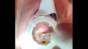 Electrosounding cervix