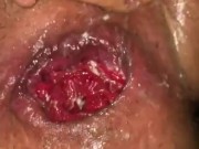 Anal Fisting And Prolapse TEASER