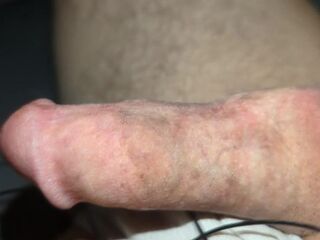 Rosebud sounding with tens and screwing machine