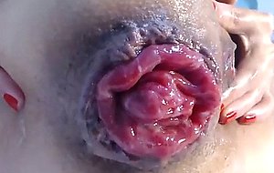 The best and her prolapse
