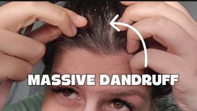 Massive Dandruff Scratching with Fork Watch the Flakes Fall (Scalp Fetish)