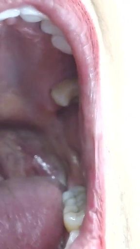 Inside My Big Mouth Tongue Teeth Uvula