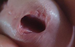 Scarred Frenulum Causes Glans Erection!