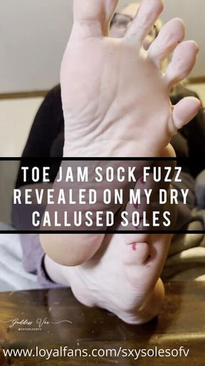 Toe Jam Sock Fuzz Revealed On My Dry Callused Soles