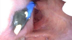 Sasha Swallows A Tiny (ENDOSCOPE FOOTAGE)