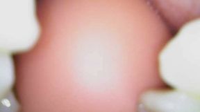 Using endoscope and cheek retractors showing side teeth and back teeth using gummy bears too