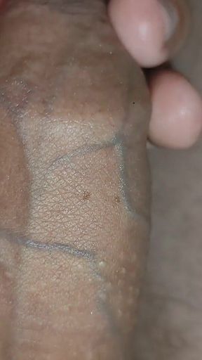 Extreme Incision of Glue Through the Glans with the Syringe.