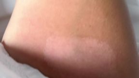 TAN LINES AND SKIN PEEL