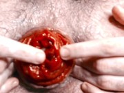 Pushing my prolapse out, fisting and showing closely my asshole