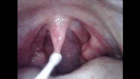 Endoscopic squeezing of stones wmv