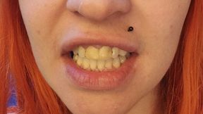 Exploring My Mouth - Extremely Yellow and Rotten Teeth