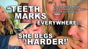 Hard Toe Biting + Finger & Arm Biting by Real Couple Tyler Girl & Tyler Boy – Teeth Marks & Playful Pain!
