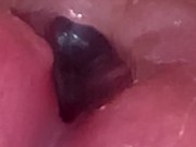 Urethral Examination