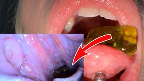 Gummy Bears Swallowed Whole + Endoscope