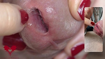 Urethral interior views of the glans