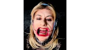 Extreme braces headgear and open mouth expander fetish