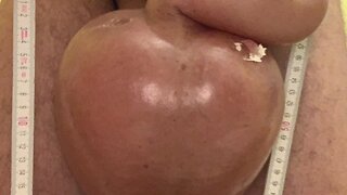 Compilation of glucose saline photos