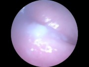 DP Endoscope for Andrew