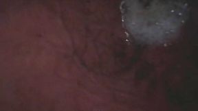Soda In My Stomach (ENDOSCOPE FOOTAGE)