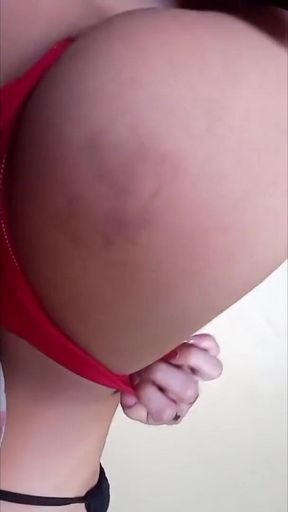 My Butt Cheek Got Purple From a Spanking