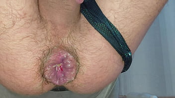 A stretched anus reveals a hemorrhoidal prolapse from riding a giant bottle. Amazing hardcore fisting at home.