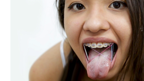 BRACES + Rubber bands ORAL SEX Elastics bands on Teeth 18yo Blowjob