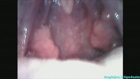 Endoscopy of sperm in the throat wmv