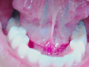 Tongue, Tonsils, and Throat Examination