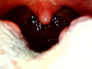 My throat with endoscope