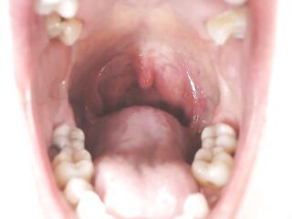 Throat and Mouth Spit Strings Uvula Tonsils Uvula