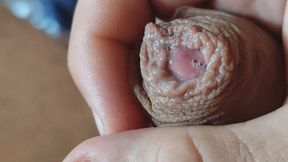 Deep Split in the Glans Produces Bubbling Liquid