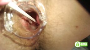 Close-up speculum view of a hairy pussy&#x270C; during a gyno exam