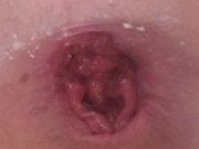my anal is so lose and broken i cant hold anything in