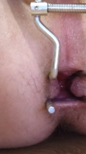 Anal dilator   Clip 1
