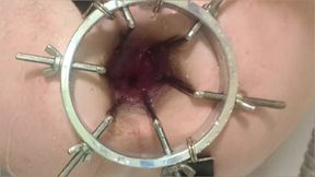 Enema, Anal Shower. Close-up View Through Anal Mirror. Anal with Water. Filling Anal with Water