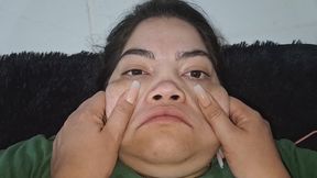 deformity of facial expression."