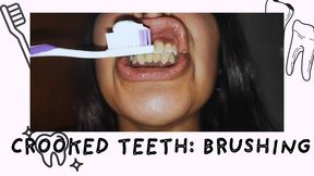 Crooked teeth: brushing clean
