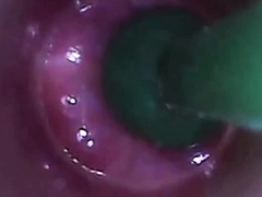 test tube cock endoscope POV urethral insertion ball rod