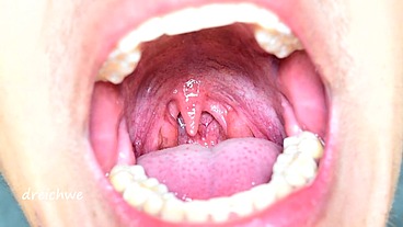 Uvula in the foreground - Collection 12