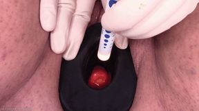 cervix swabbed with iodine (720 wmv)