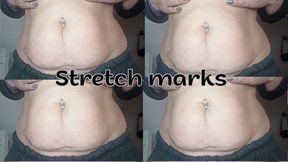 Stretch marks on my belly