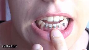 Dental appliance [MORGANA],