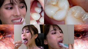 Tsubaki Hanai - Observing Tsubaki's teeth, mouth, and back of the throat with a dental camera - MOV