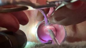 frozen sound penetrates cervix with tenaculum