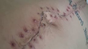 Scar Fetishes Stitches Staples Hospital Recovery After Surgery Teen Petite Small Waist