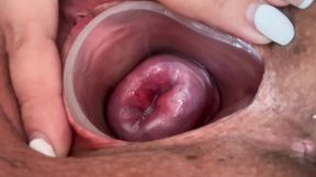 Tiny cervix without dilation