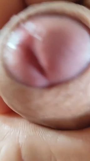 Opening the Scar of the Rough Frenulum!